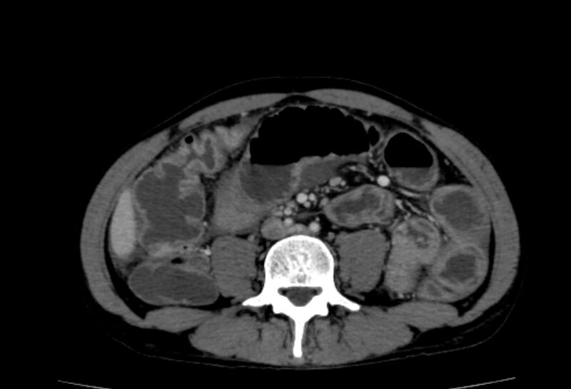 File:Behçet's disease- abdominal vasculitis (Radiopaedia 55955-62570 A 47).jpg