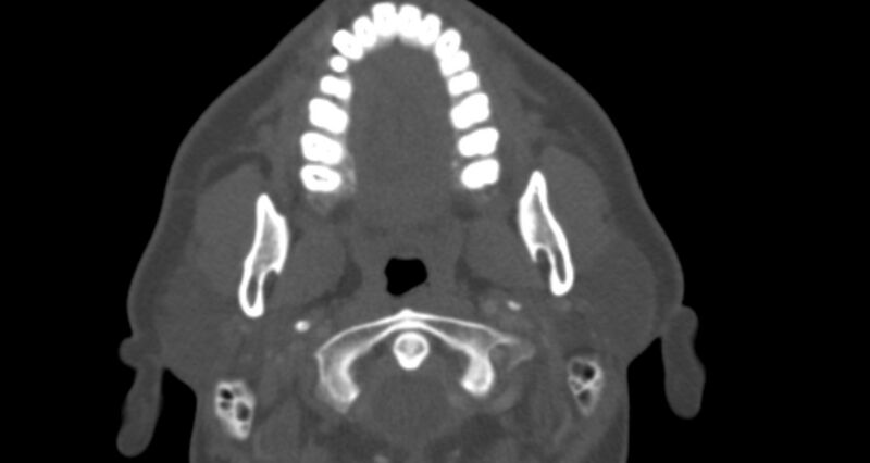 File:Benign mixed salivary tumor of the parotid gland (Radiopaedia 35261-36792 Axial bone window 16).jpg