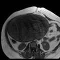 Benign seromucinous cystadenoma of the ovary (Radiopaedia 71065-81300 Axial T1 26).jpg
