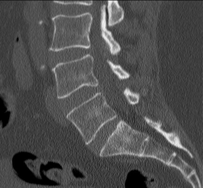 File:Bertolotti syndrome (Radiopaedia 24864-25128 Sagittal bone window 31).jpg