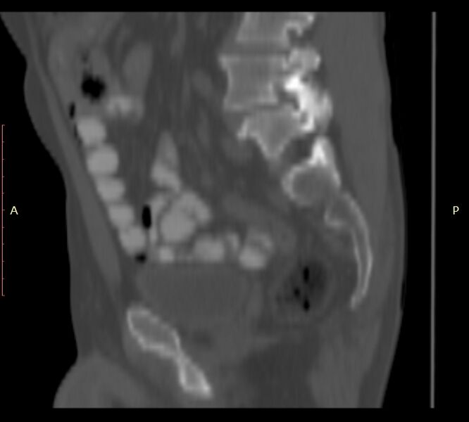 File:Bertolotti syndrome (Radiopaedia 58974-66235 Sagittal bone window 36).jpg