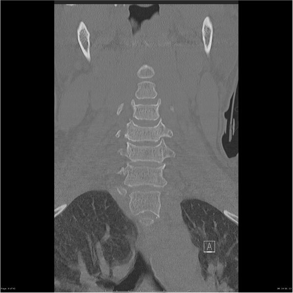 File:Bilateral cervical ribs (Radiopaedia 25868-26017 Coronal bone window 9).jpg