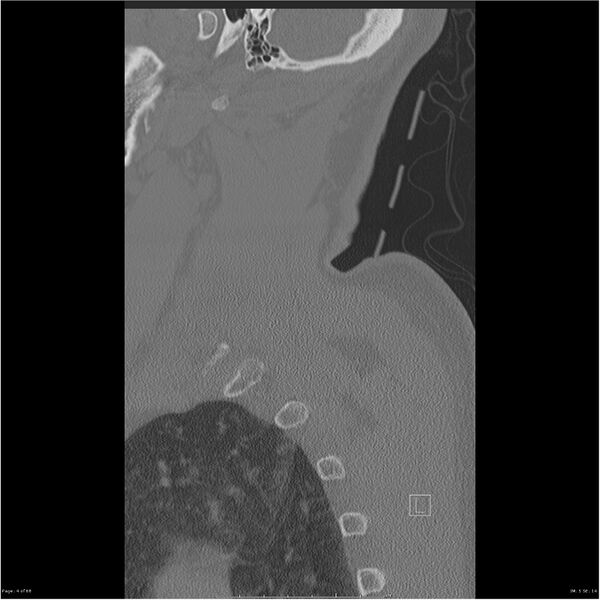 File:Bilateral cervical ribs (Radiopaedia 25868-26017 Sagittal bone window 4).jpg