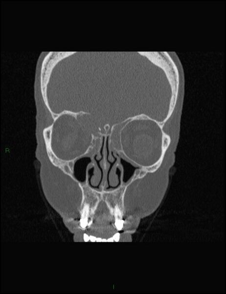 File:Bilateral frontal mucoceles (Radiopaedia 82352-96454 Coronal 116).jpg