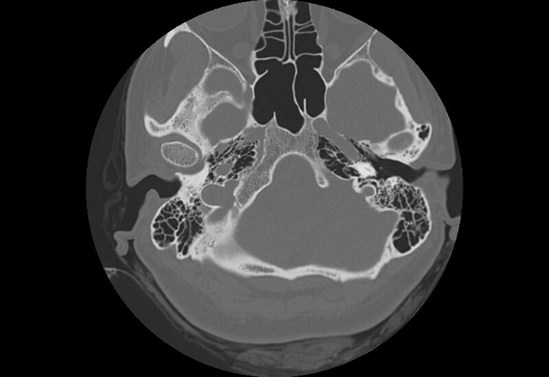 File:Bilateral otospongiosis (Radiopaedia 35447-36940 Axial bone window 17).jpg