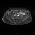 Bilateral ovarian fibroma (Radiopaedia 44568-48293 Axial T1 C+ fat sat 2).jpg