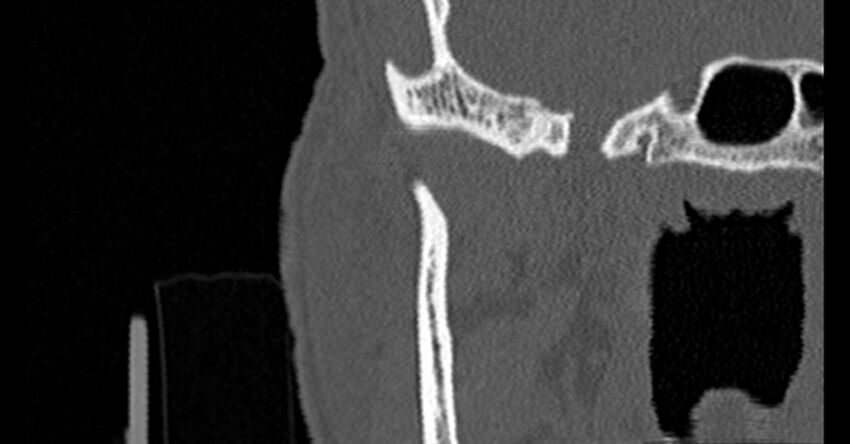 Bilateral temporal bone fractures (Radiopaedia 29482-29970 Coronal non-contrast 21).jpg
