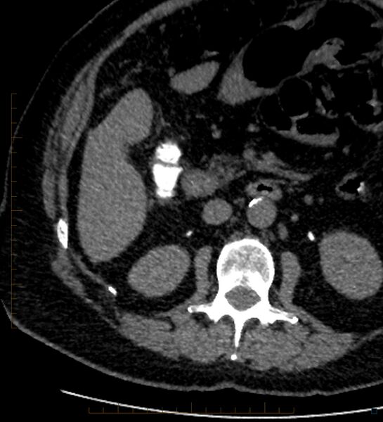 File:Bile leak from accessory duct(s) of Luschka post cholecystectomy (Radiopaedia 40736-43389 A 48).jpg