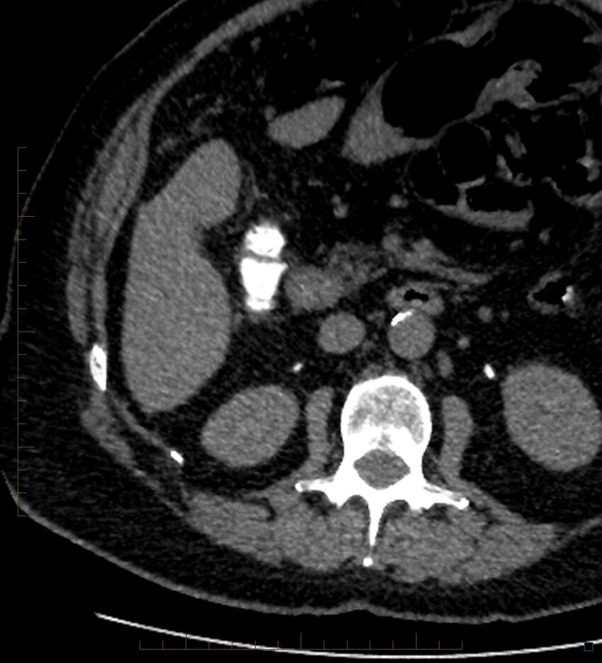 Bile leak from accessory duct(s) of Luschka post cholecystectomy (Radiopaedia 40736-43389 A 48).jpg