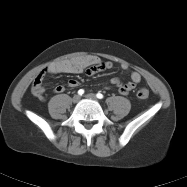 File:Biliary necrosis - liver transplant (Radiopaedia 21876-21845 A 46).jpg