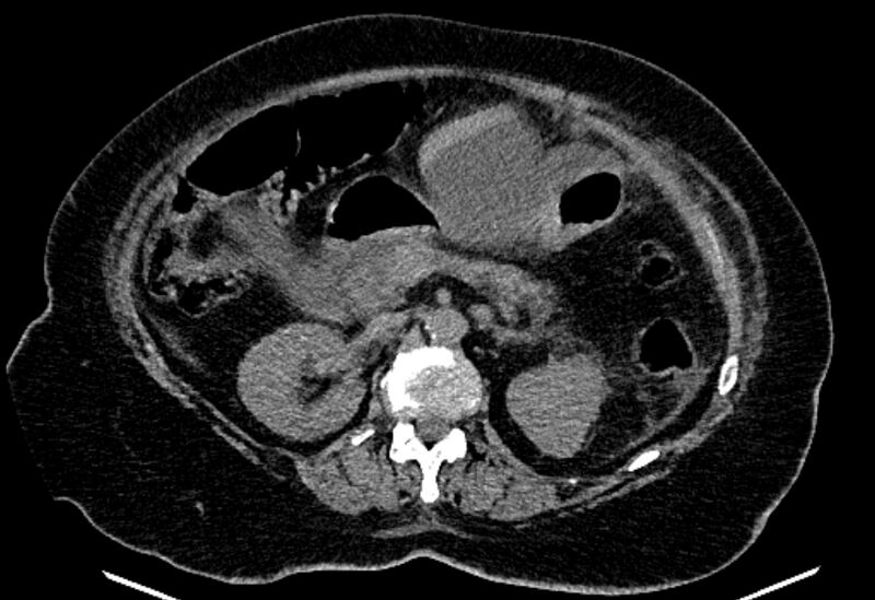 File:Biliary pancreatitis (Radiopaedia 72289-82823 Axial non-contrast 106).jpg