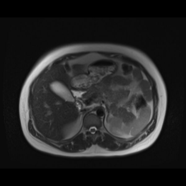 File:Bilobed placenta accreta (Radiopaedia 69648-79591 Axial T2 5).jpg