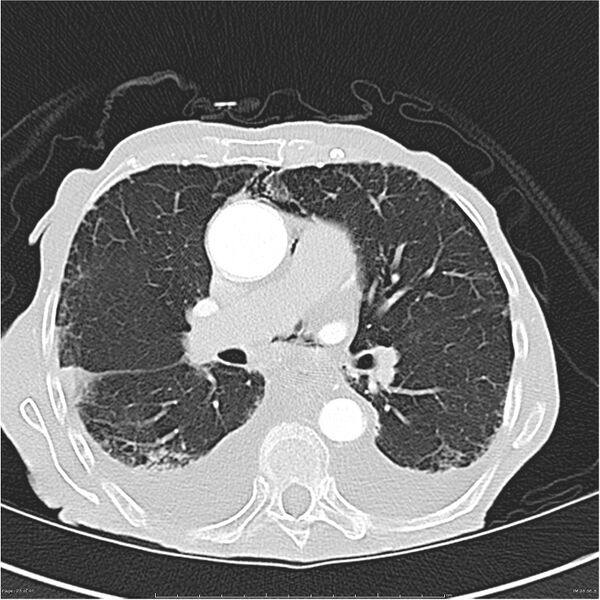 File:Boerhaave syndrome (Radiopaedia 26240-26362 Axial lung window 23).jpg