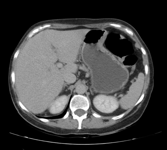 File:Bosniak renal cyst - type IV (Radiopaedia 22929-22953 D 14).jpg