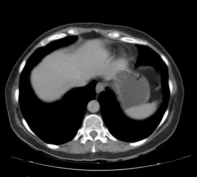 File:Bosniak renal cyst - type IV (Radiopaedia 22929-22953 D 5).jpg