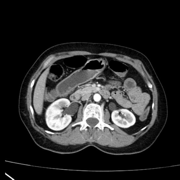 File:Bosniak renal cyst - type I (Radiopaedia 27479-27675 renal cortical phase 33).jpg