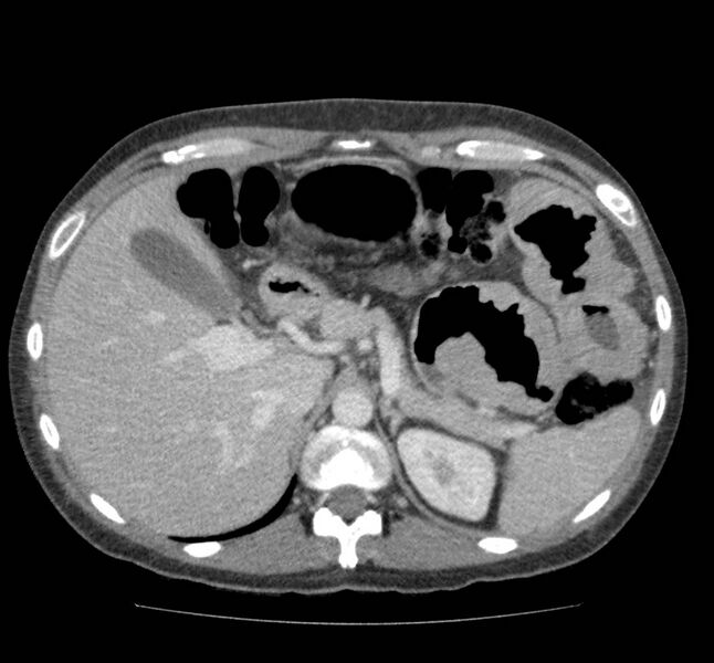 File:Bowel lymphoma complicated by bleeding after therapy (Radiopaedia 55601-62107 A 22).jpg