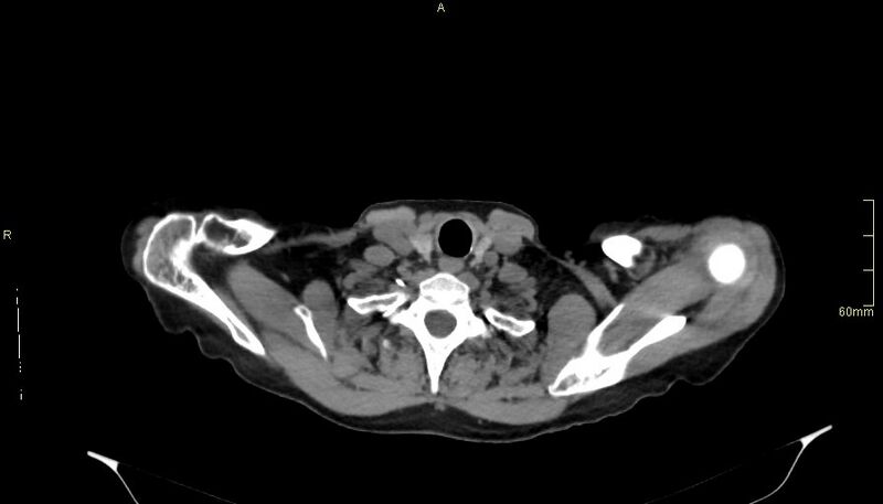 File:Brachial artery foreign body (Radiopaedia 54583-60820 Axial non-contrast 7).jpg