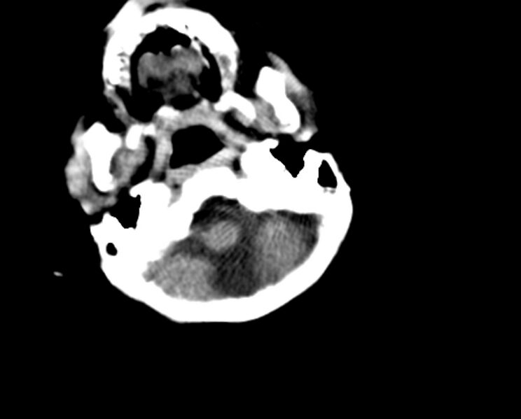 File:Brachycephaly (bi-coronal and bi-lambdoid synostosis) (Radiopaedia 55048-61413 Axial non-contrast 7).jpg