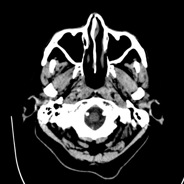 File:Brain Pantopaque remnants (Radiopaedia 78403-91048 Axial non-contrast 17).jpg