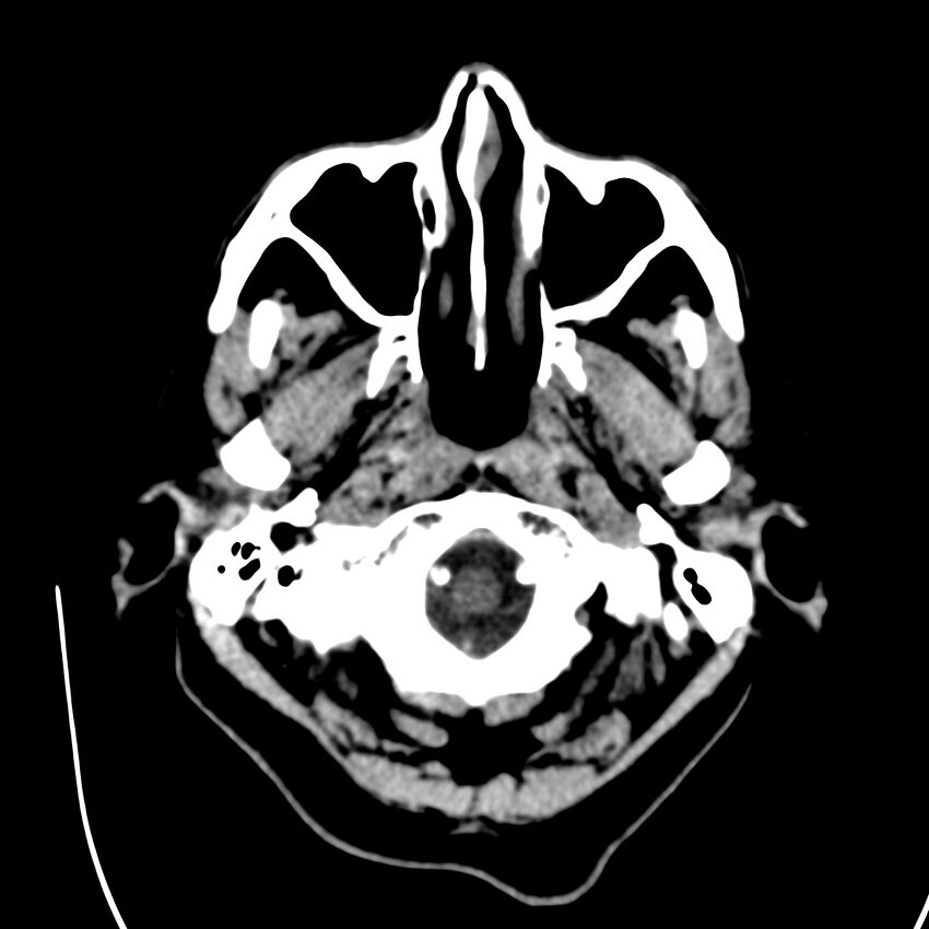 Brain Pantopaque remnants (Radiopaedia 78403-91048 Axial non-contrast 17).jpg