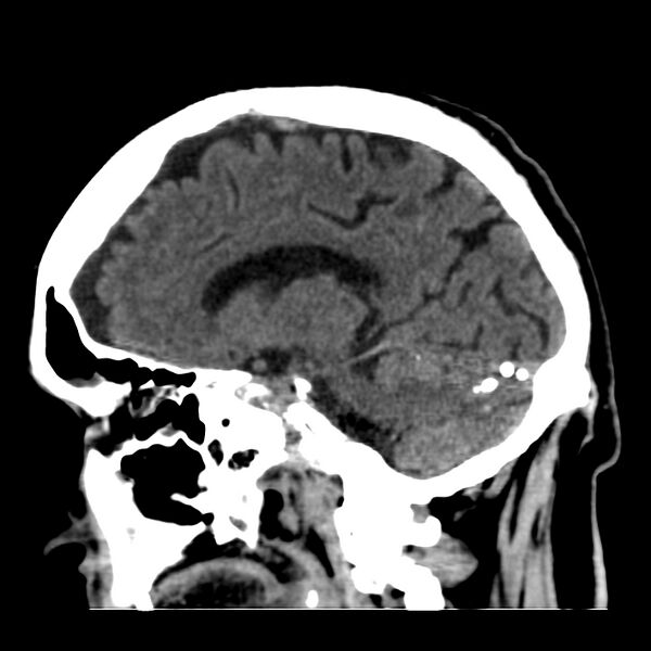 File:Brain Pantopaque remnants (Radiopaedia 78403-91048 C 24).jpg