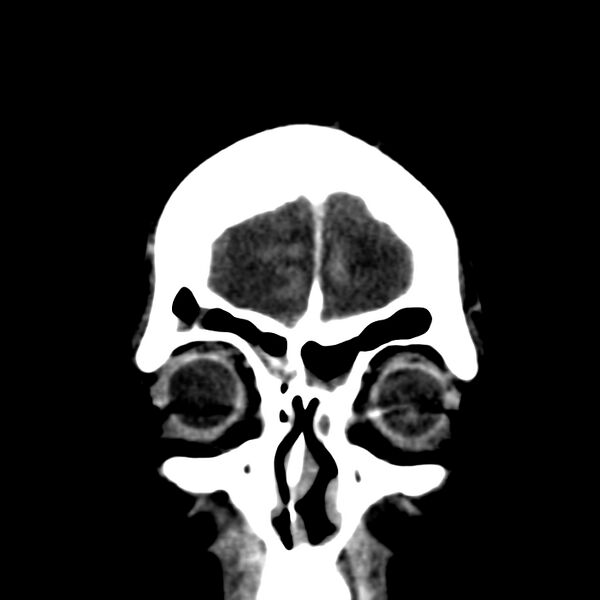 File:Brain Pantopaque remnants (Radiopaedia 78403-91048 Coronal non-contrast 8).jpg