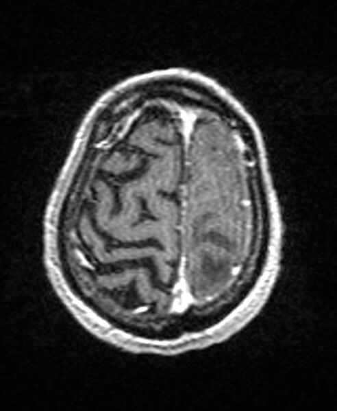 File:Brain abscess with dual rim sign (Radiopaedia 87566-103938 Axial T1 C+ 139).jpg