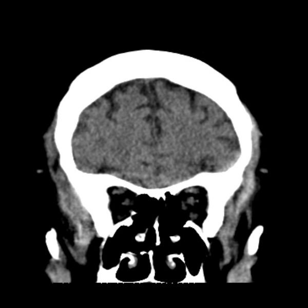 File:Brain cortical laminar necrosis (Radiopaedia 25822-25971 C 14).jpg