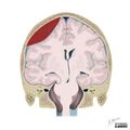 Brain herniation types (Radiopaedia 45683-49865 A 1).jpg