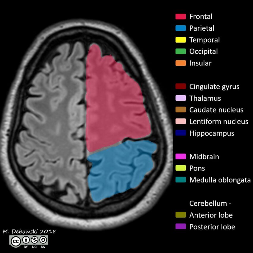 Brain lobes - annotated MRI (Radiopaedia 61691-69700 Axial 16).JPG