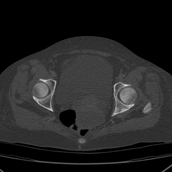 File:Breast cancer metastases - hepatic and skeletal (Radiopaedia 34201-35461 Axial bone window 101).jpg