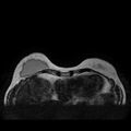 Breast implants - MRI (Radiopaedia 26864-27035 Axial T2 9).jpg