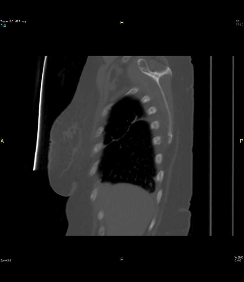 Breast primary with lung and bone metastases (Radiopaedia 40620-43228 Sagittal bone window 14).jpg