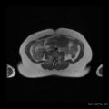 Broad ligament fibroid (Radiopaedia 49135-54241 Axial T1 2).jpg