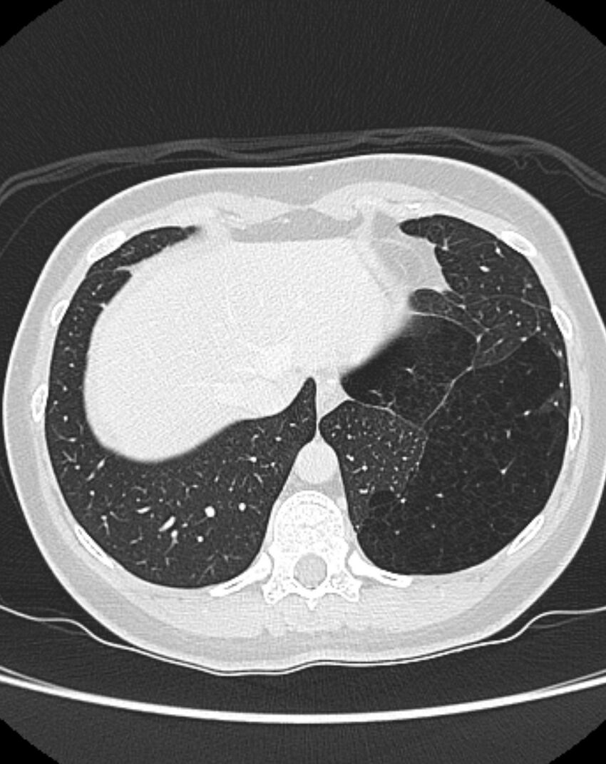 Bronchial atresia (Radiopaedia 50007-55297 Axial lung window 91).jpg