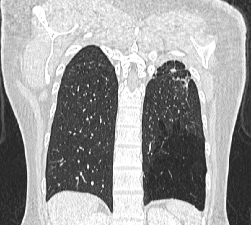 Bronchial atresia (Radiopaedia 50007-55297 Coronal lung window 96).jpg
