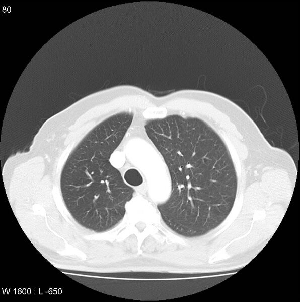 File:Bronchial carcinoid tumor with right lower lobe collapse (Radiopaedia 29060-29422 B 18).jpg