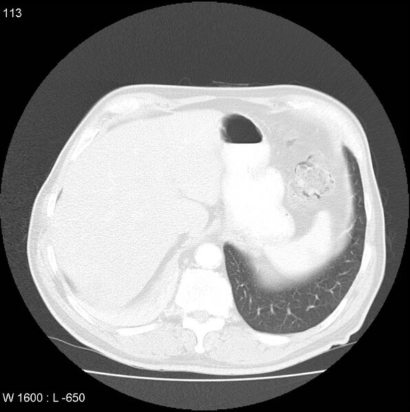 File:Bronchial carcinoid tumor with right lower lobe collapse (Radiopaedia 29060-29422 B 51).jpg