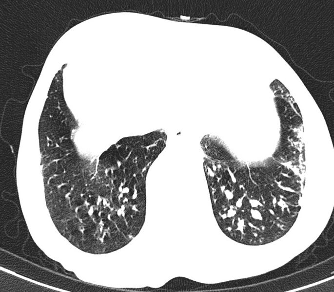 File:Bronchiolitis (Radiopaedia 24616-24887 Axial lung window 52).jpg