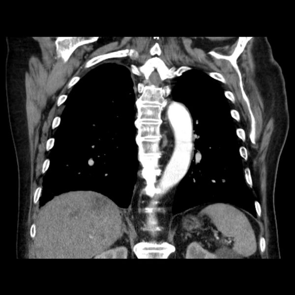 File:Bronchogenic adenocarcinoma and pulmonary embolism (Radiopaedia 9097-9806 C 35).jpg