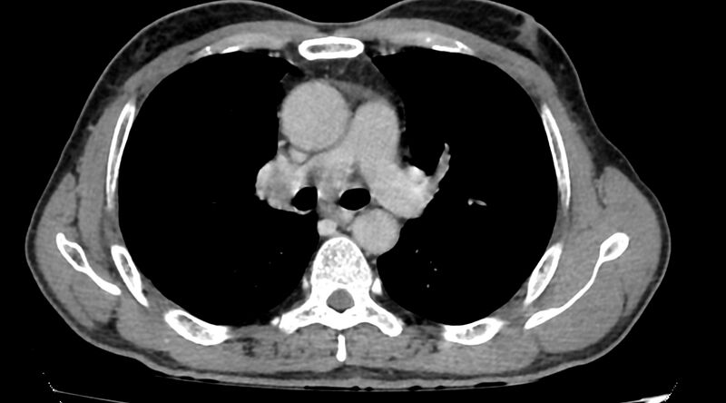 File:Bronchogenic carcinoma with superior vena cava syndrome (Radiopaedia 36497-38054 Axial C+ delayed 42).jpg