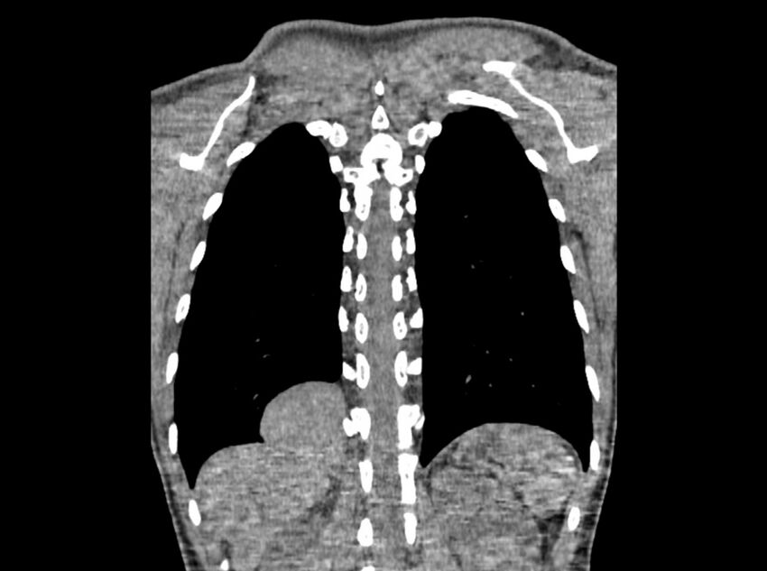 Bronchogenic cyst (Radiopaedia 80273-93615 D 111).jpg