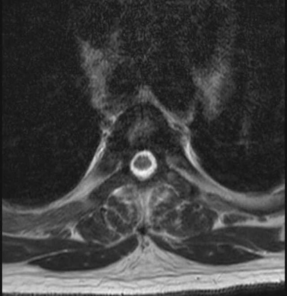 File:Brown tumors compressing the spinal cord (Radiopaedia 68442-78030 A 41).jpg