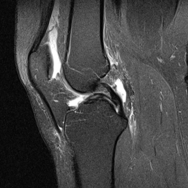 File:Bucket handle tear - medial meniscus (Radiopaedia 79028-91942 Sagittal PD fat sat 13).jpg