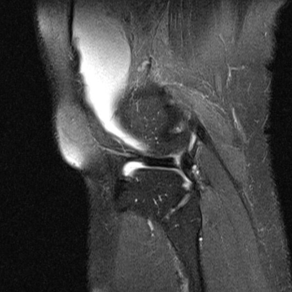 File:Bucket handle tear - medial meniscus (Radiopaedia 79028-91942 Sagittal PD fat sat 3).jpg