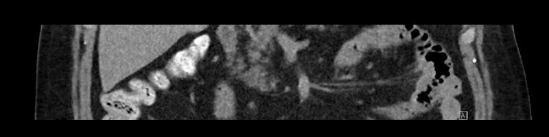 File:Buried bumper syndrome - gastrostomy tube (Radiopaedia 63843-72575 Coronal Inject 42).jpg