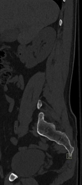 File:Calcaneal fractures with associated L2 burst fracture (Radiopaedia 71671-82493 Sagittal bone window 72).jpg