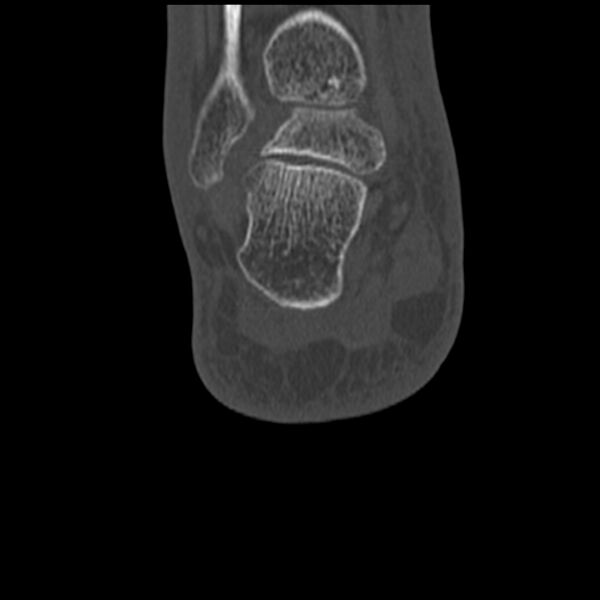 File:Calcaneal tuberosity avulsion fracture (Radiopaedia 22649-22668 Coronal bone window 55).jpg