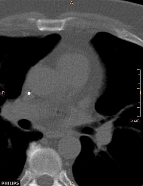 File:Calcified cardiac fibroma (Radiopaedia 39267-41519 Axial bone window 9).jpg